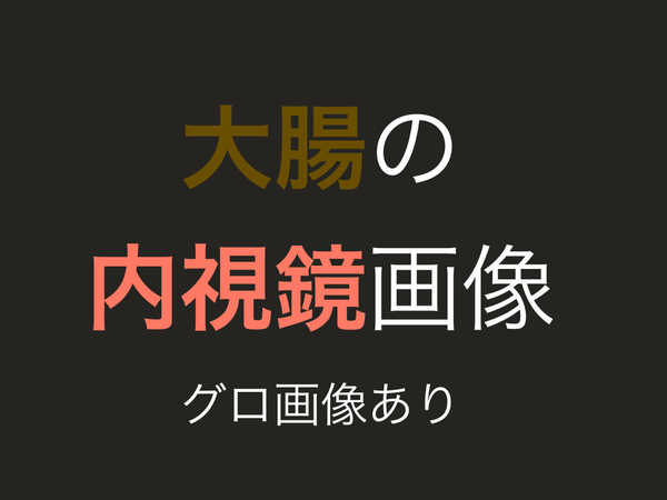大腸の内視鏡画像あり