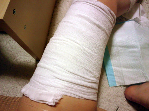 タトゥー・入れ墨除去経過ブログ : 手術から6日目+かゆい・・