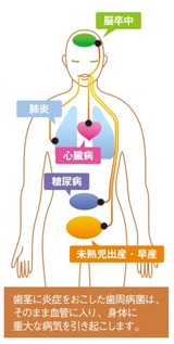 歯周病が招く怖い病気