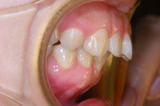 voice13-before-side