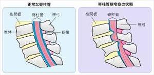 狭窄症