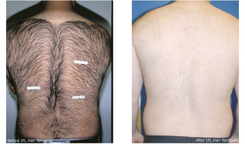 ipl-before-after