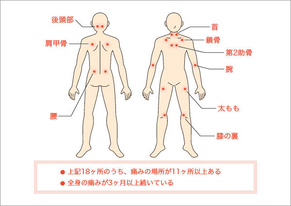 線維筋痛症,よもぎブログ,辛い,発症,ずっと痛い,激痛,マッサージ