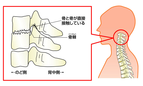 線維筋痛症,後弯症,頚椎症,首や身体.神経の痛み,激痛,嘔吐,辛い