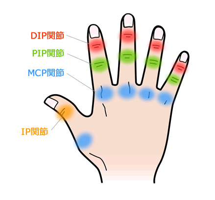 rheumatism3