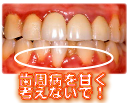 歯周病