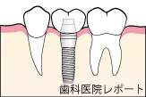 インプラント