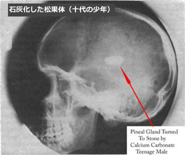 松果体石灰化 pineal-gland-calcification