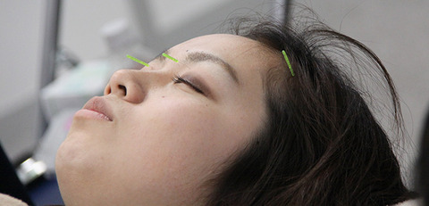 美顔になる美容鍼灸5