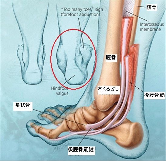 ハーフタイム後のボディ・マネジメント 後脛骨筋腱炎 ハーフタイム後のボディ・マネジメント 後脛骨筋腱炎