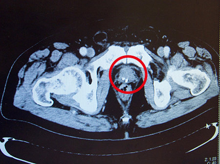 prostate1