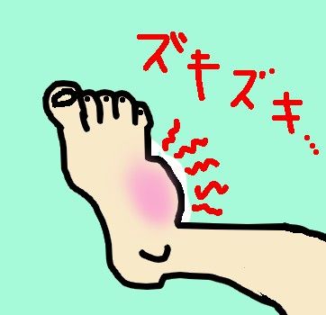 捻挫