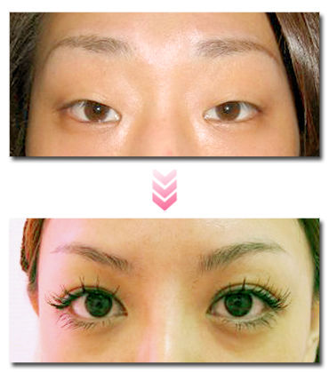 アイプチ要らず キレイで自然な二重にする方法 二重整形 まとめ