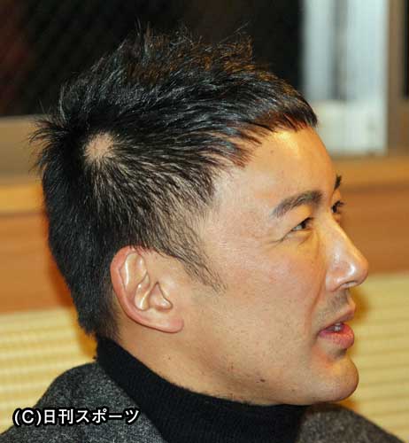 円形脱毛症になった芸能人たち 1 2 脱毛 情報館 美容 エステ スキンケア