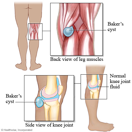 嚢胞 ベーカー ベーカー嚢腫破裂と下肢静脈血栓症の鑑別