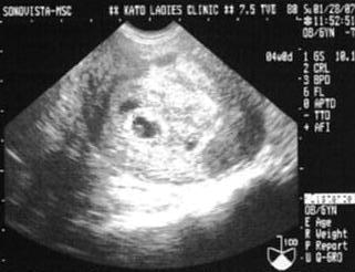 ６ｗ４ｄ ｂｔ２７日目 心拍確認 ３６歳からの子づくり