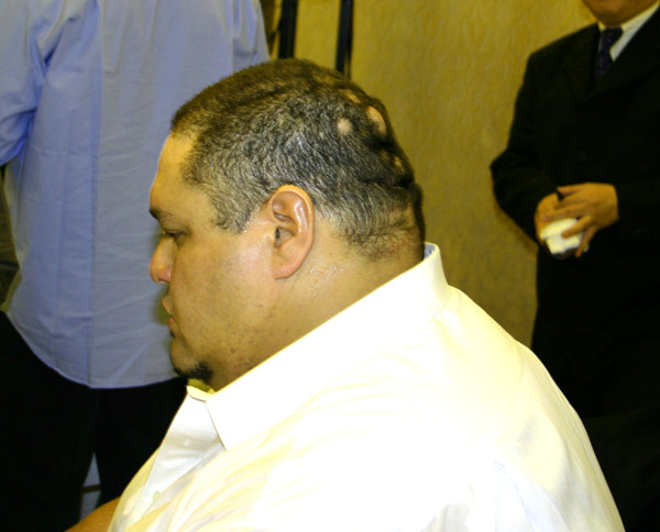 曙 : 円形脱毛症になった芸能人たち - NAVER まとめ