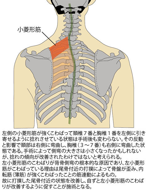側弯症(小菱形筋「こ」)