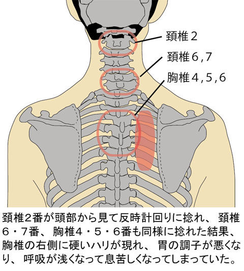 胸椎の捻れによる背中のハリと胃の不調