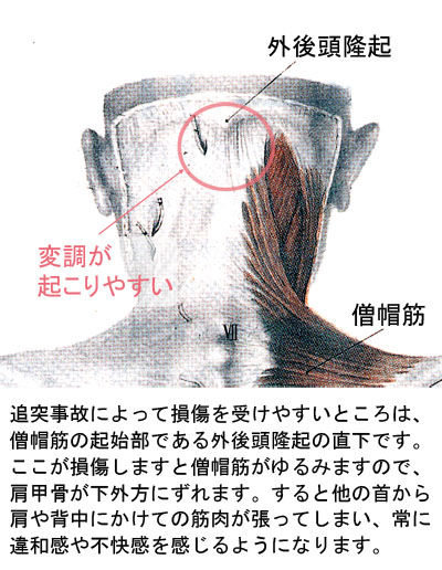 ムチウチ変調の場所