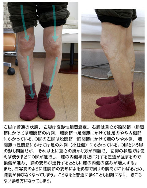 変形性膝関節症01