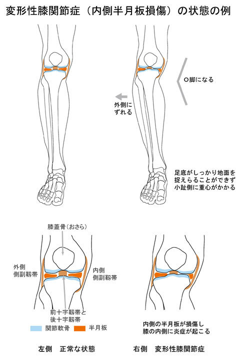 変形性膝関節症(半月板損傷)