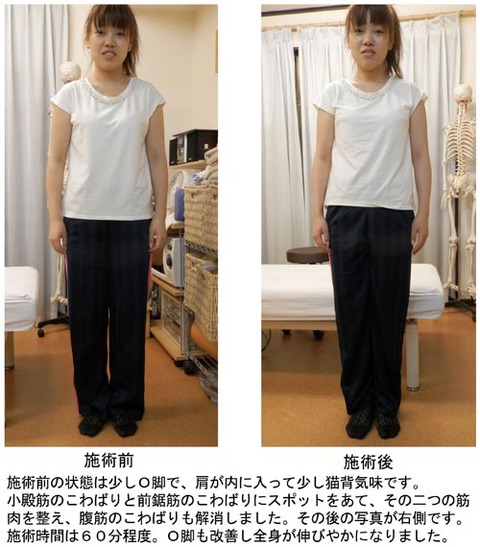 O脚と猫背の改善