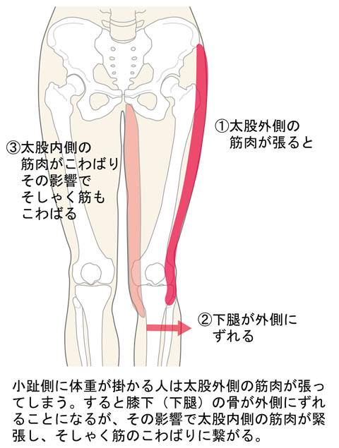 下腿が外側にズレる
