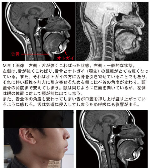 舌のつよいこわばり