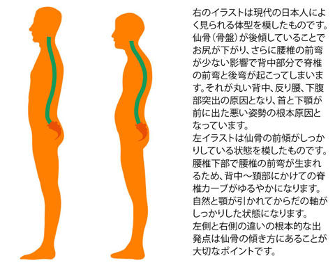 骨盤の前傾と後傾比較