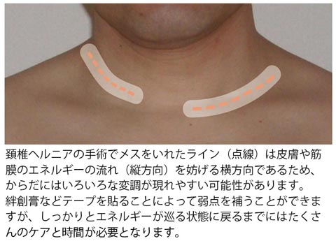 手術痕の影響_頚椎ヘルニア