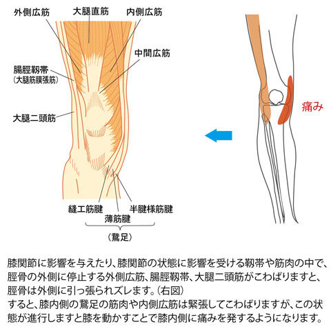 脛骨のズレによる膝内側の痛み