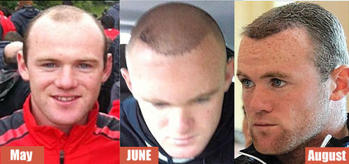 wayne-rooney-before-after-hair-transplant-thumb-500x235-4172