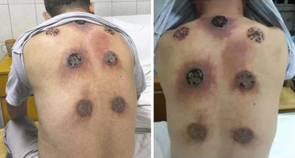 cupping-feature-e1466719915513