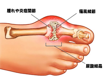 痛風