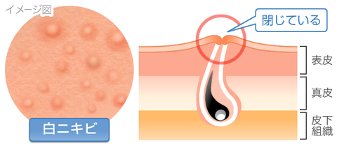 白ニキビ