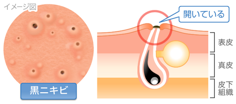 黒ニキビ