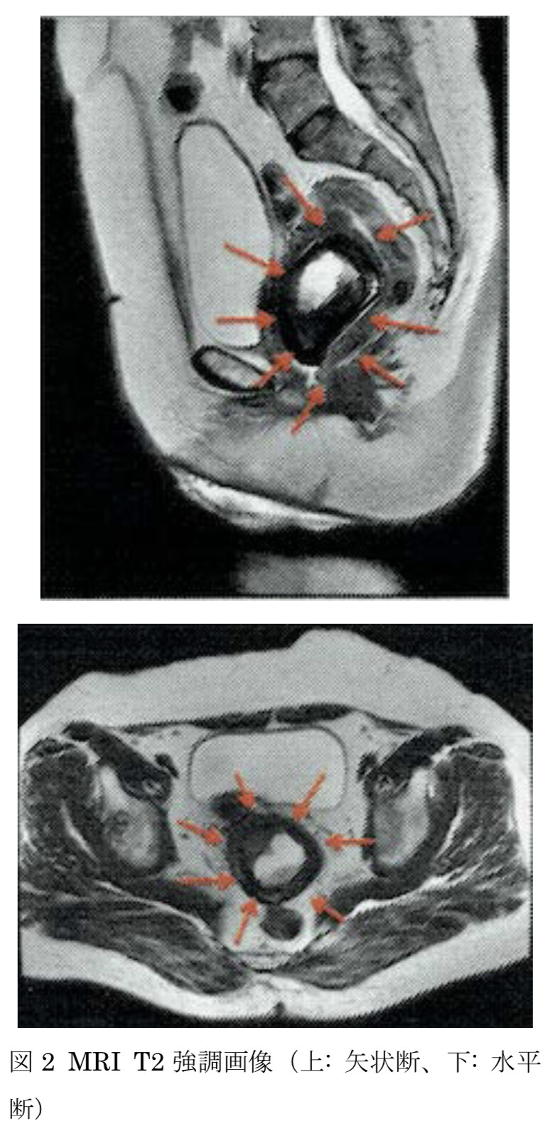 MRI まんこ 