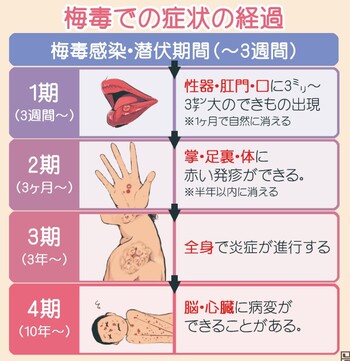 梅毒にマッチングアプリで感染