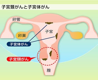 ヒト・パピローマ・ウイルス