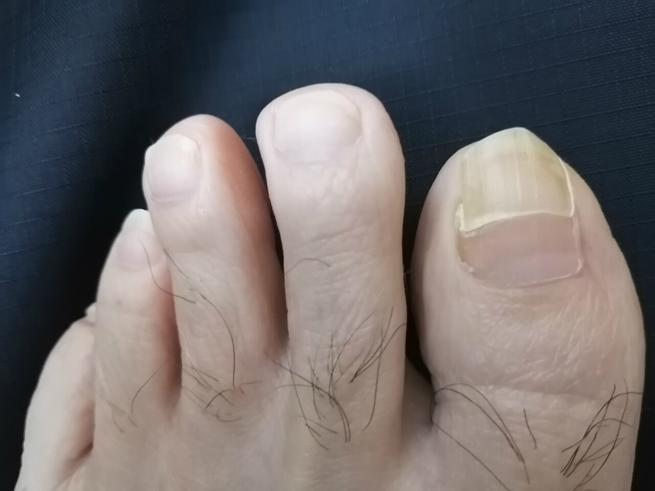 ヒマネタ 足の爪が生え変わるのに１年 ２年も 丹沢ｚ３の気まぐれブログ