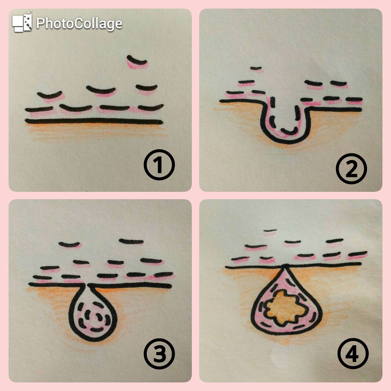 7月14日 土 粉瘤について 夫婦でアボカドをながめているブログ