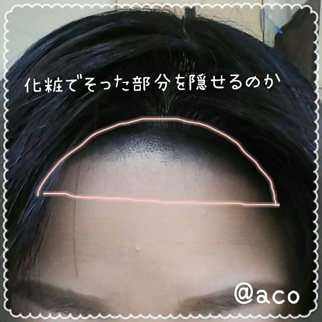 おでこ脱毛6 剃った頭を隠すの巻 Ipi おでこ脱毛6 剃った頭を隠すの巻 Ipi