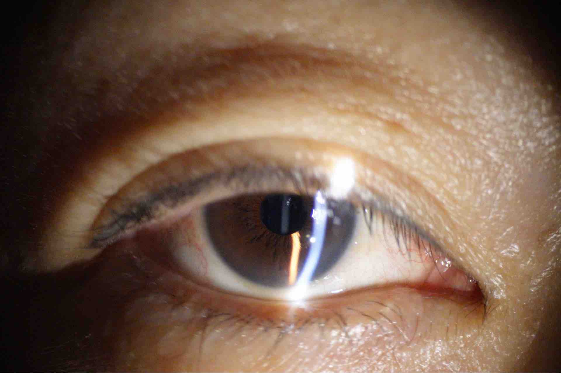 眼瞼下垂手術 あだち眼科のブログ