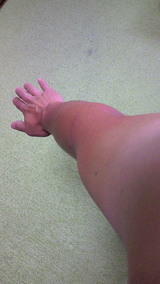 sunburn