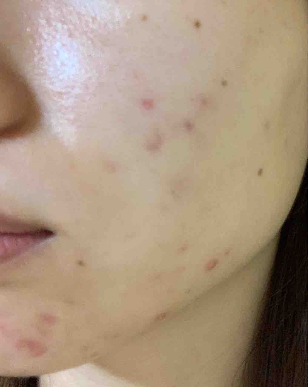 ニキビ改善18日目 Diary