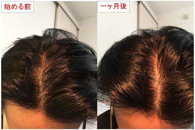 Aga治療開始から 一ヶ月後の初期脱毛について 徹底検証 Aga治療って本当に効果あるの Aga治療開始から 一ヶ月後の初期脱毛について 徹底検証 Aga治療って本当に効果あるの