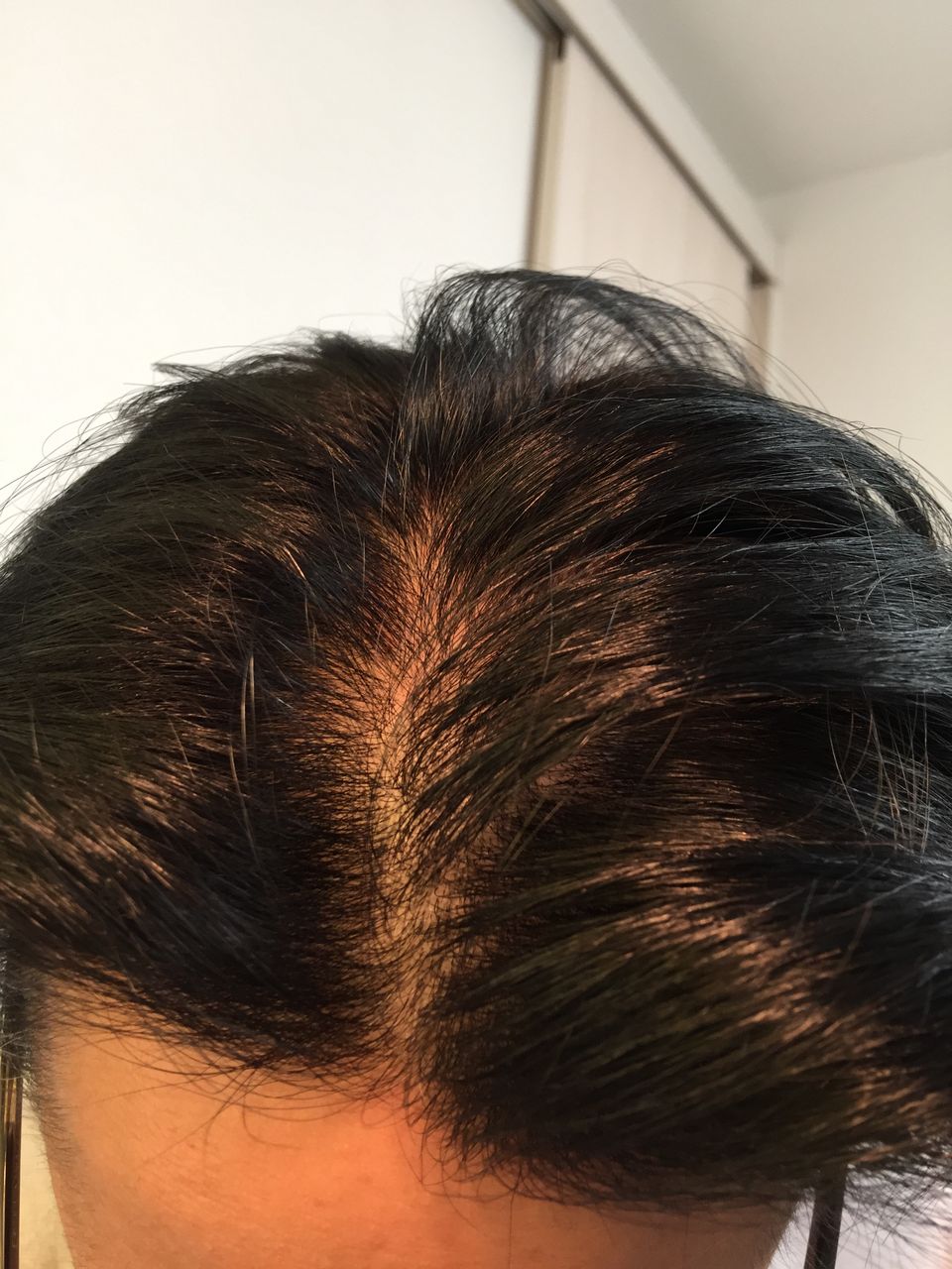 Aga治療を決意 徹底検証 Aga治療って本当に効果あるの Aga治療を決意 徹底検証 Aga治療って本当に効果あるの