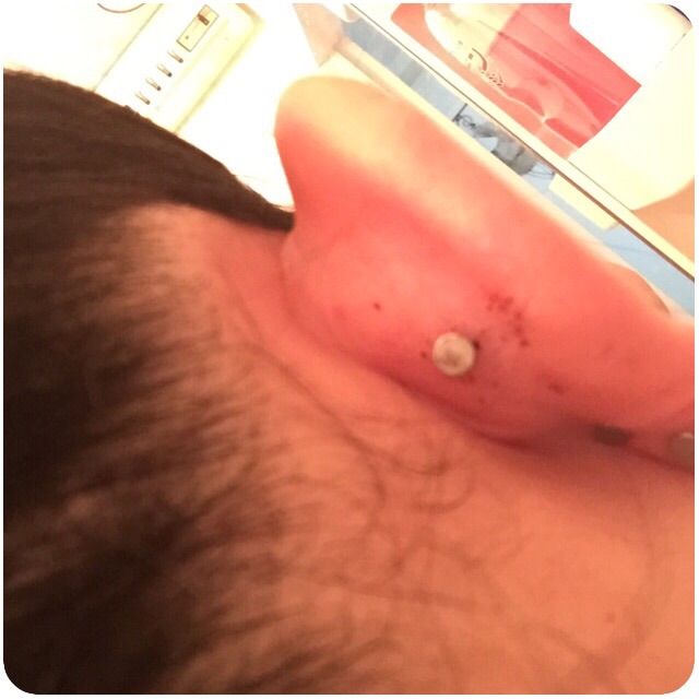 インナーコンク ニードル セルフ アーニャの日記