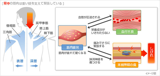 肩こりって なーに ジャービルのblog 肩こりって なーに ジャービルのblog